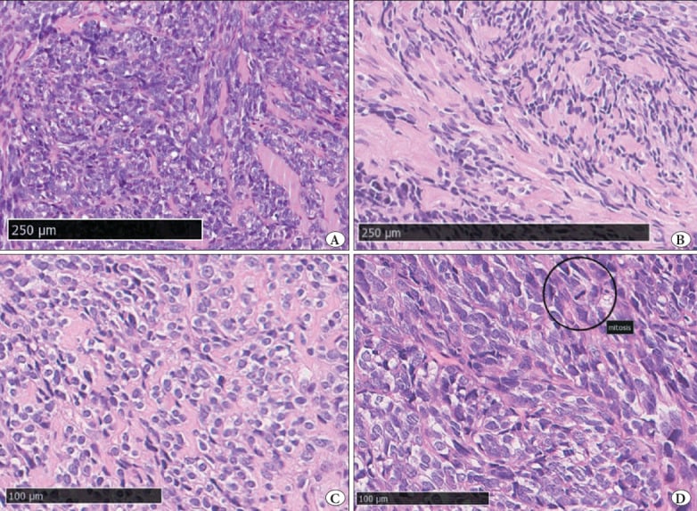 Needle-biopsy histology of mesenchymal chondrosarcoma showing a small round cell tumour, hyalinised spindle areas, osteoid-like stroma and mitoses without obvious cartilage