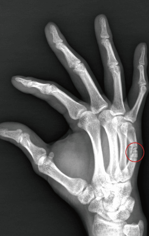 Boxer's fracture - 5th metacarpal neck fracture on X-ray