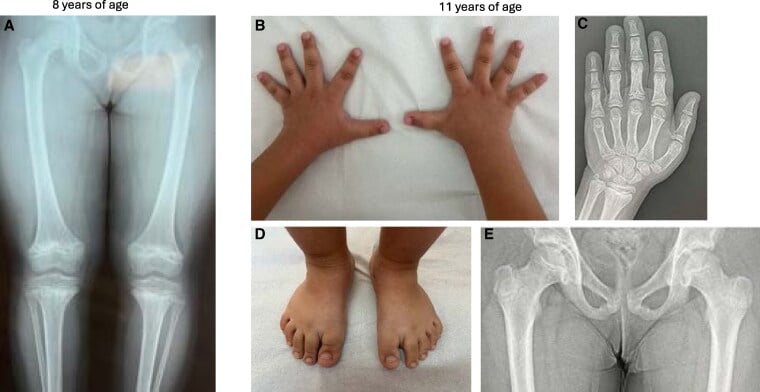 Composite radiographs of the lower limbs, hand and pelvis with clinical photographs of the hands and feet in a metaphyseal dysplasia
