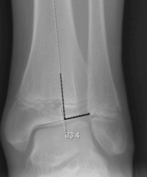 Radiograph showing measurement of the lateral distal tibial angle