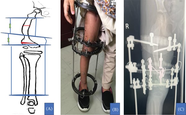 Drawing and photograph of a four-ring Ilizarov frame with cortectomy sites and distraction directions marked
