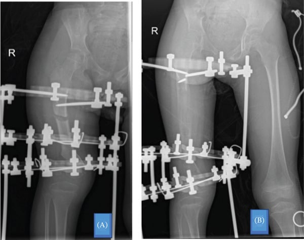 Serial anteroposterior radiographs during distraction showing progressive lengthening and regenerate formation