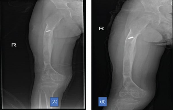Radiographs after frame removal showing consolidated regenerate and a horizontal knee joint line