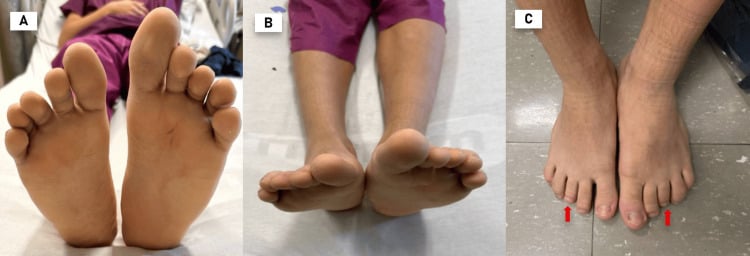 Clinical photographs of the feet and lower legs demonstrating limb-length and foot-size asymmetry