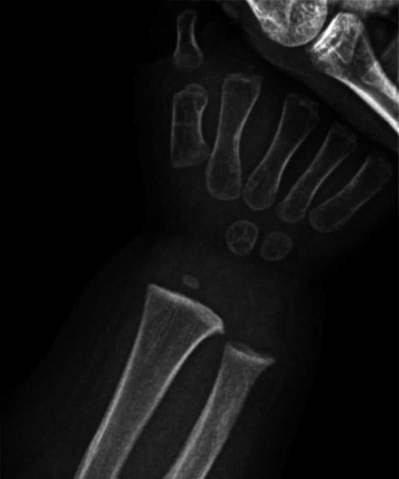 Anteroposterior wrist radiograph showing metaphyseal flaring of the distal radius and ulna