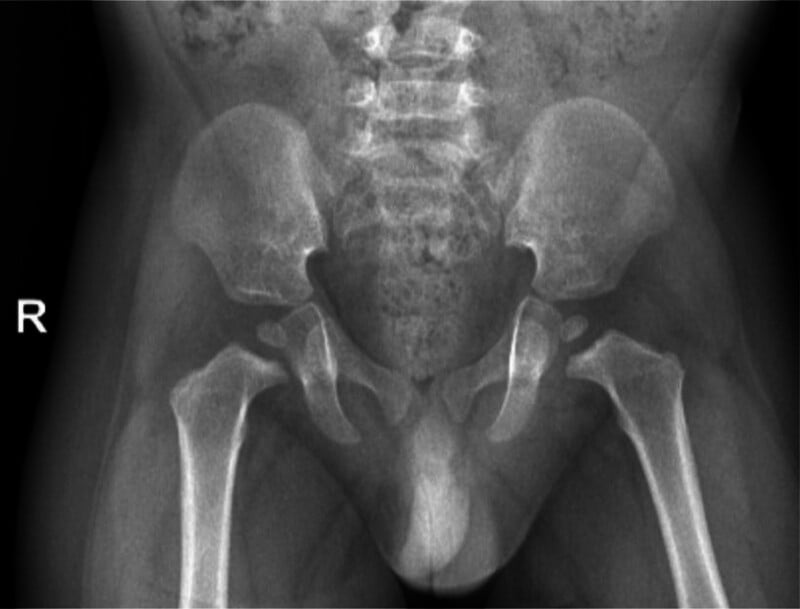 Anteroposterior hip radiograph showing bilateral coxa vara
