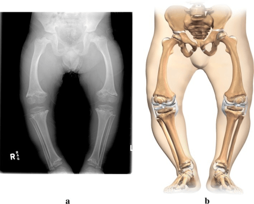 Anteroposterior lower-limb radiograph and illustration of deformity in cartilage-hair hypoplasia