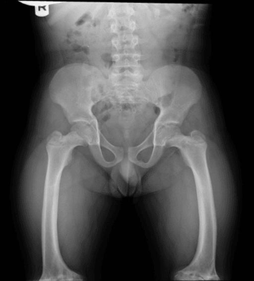 Anteroposterior radiograph demonstrating coxa vara and femoral bowing