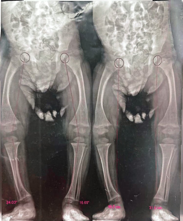Standing long-leg radiograph with mechanical axis deviation angles measured bilaterally