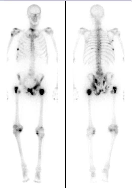 Whole-body bone scintigraphy showing multiple skeletal metastases