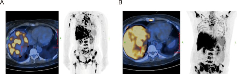 Serial PET-CT showing skeletal metastatic disease during systemic treatment