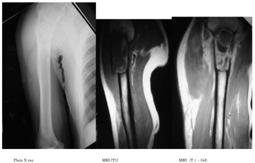 Radiograph and MRI showing an osteolytic metastatic lesion with pathological fracture