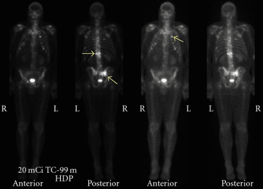 Anterior and posterior bone scans showing multiple skeletal metastases