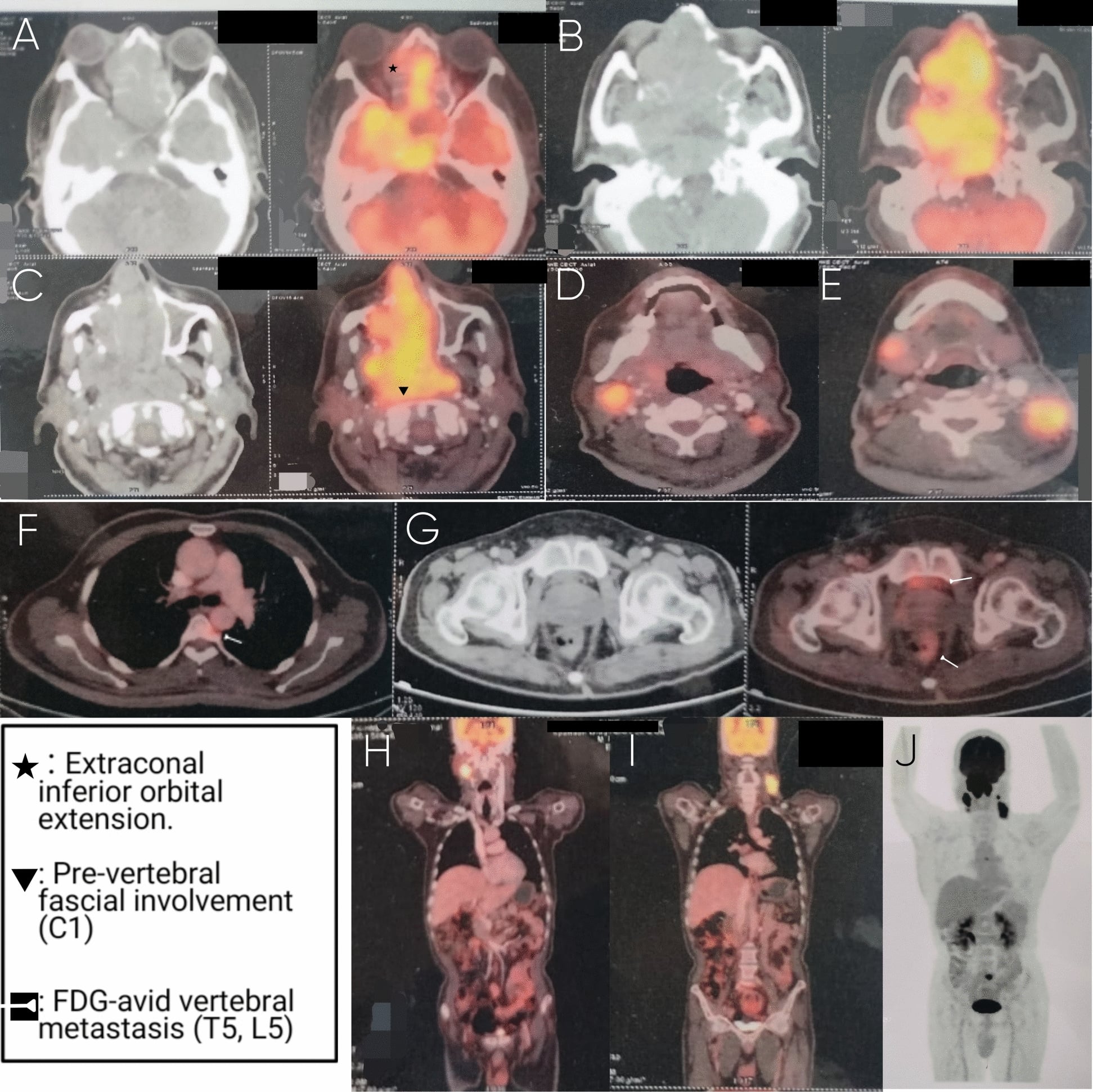 Whole-body FDG PET-CT showing primary tumour and metastatic spread