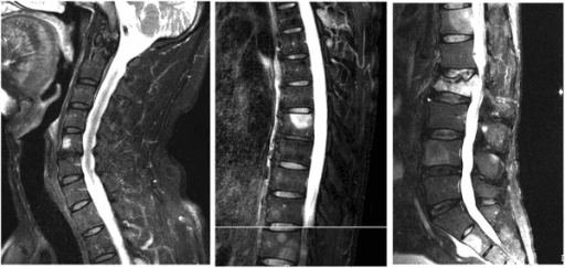 MRI showing vertebral marrow metastases with pathological fracture