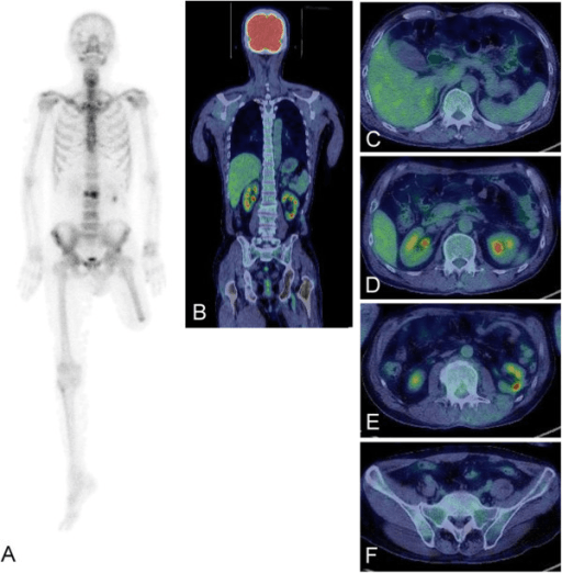 Bone scan and CT of a metastatic vertebral fracture