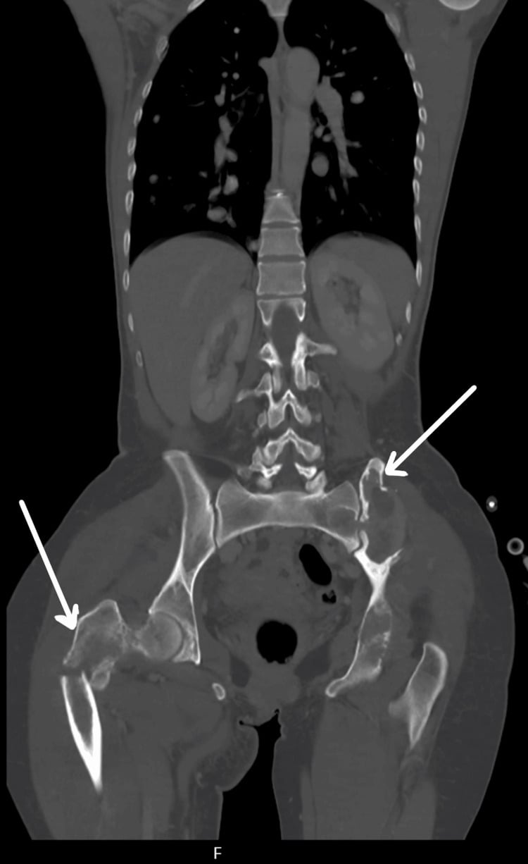 CT showing a lytic proximal femoral metastasis and pulmonary lesion