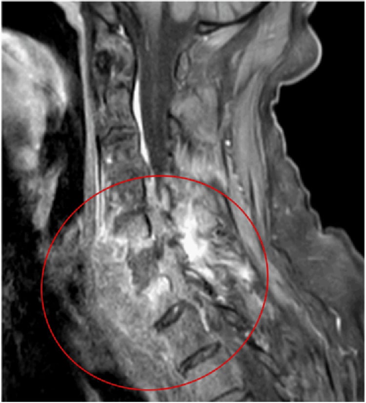 MRI showing cervical spinal cord compression from vertebral metastasis