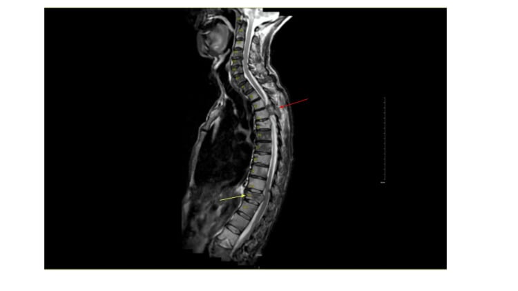 MRI showing thoracic metastatic disease with cord compression and pathological fracture