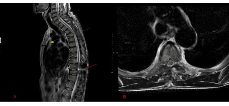 Postoperative MRI after decompression for metastatic spinal cord compression