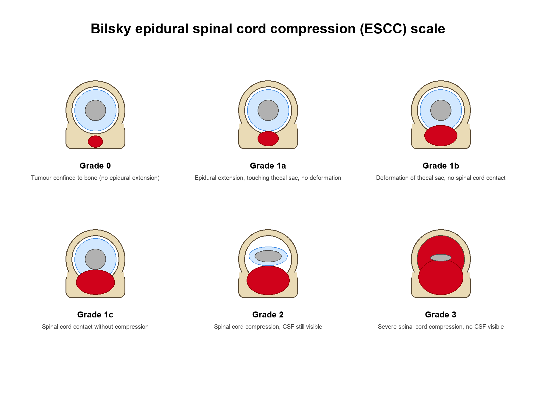 Axial diagram of the six-point Bilsky epidural spinal cord compression scale from bone-only disease to circumferential cord compression