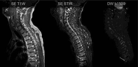 Three-sequence sagittal cervicothoracic spine MRI showing multilevel vertebral metastases on T1, STIR and diffusion-weighted imaging