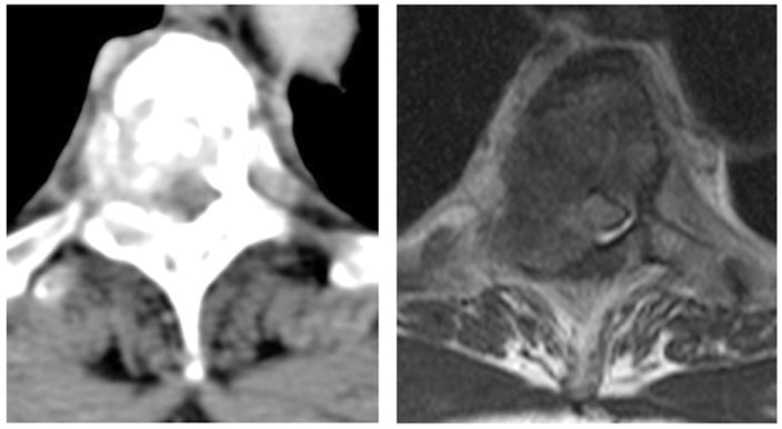 Matched axial CT and T2 MRI showing Bilsky grade 3 metastatic epidural spinal cord compression