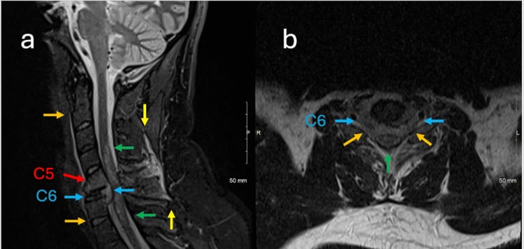 Sagittal STIR and axial T2 MRI of C6 metastatic collapse with spinal cord compression