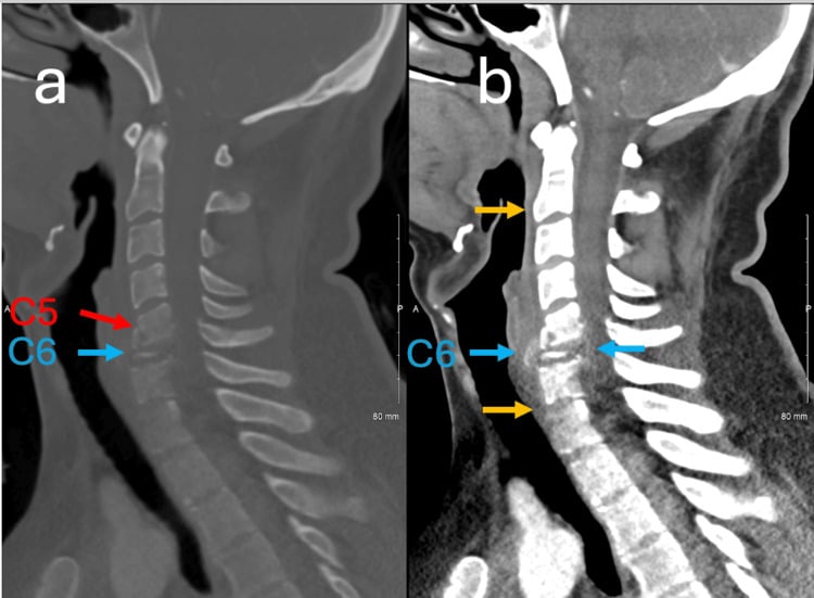Sagittal bone and soft-tissue CT of destructive C6 metastasis with pathological fracture