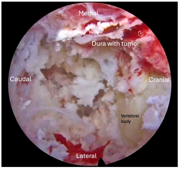 Endoscopic transpedicular decompression of ventral epidural metastatic tumour