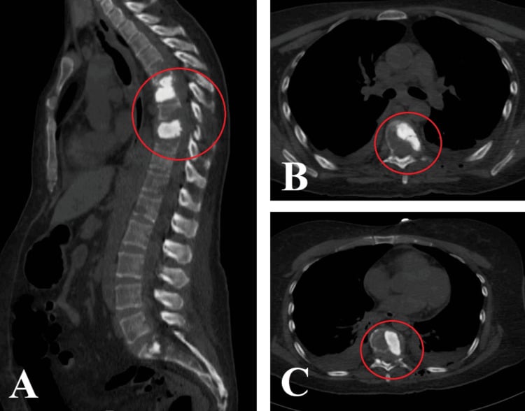 Sagittal and axial CT after vertebral augmentation and posterior-wall corpectomy for thoracic metastases