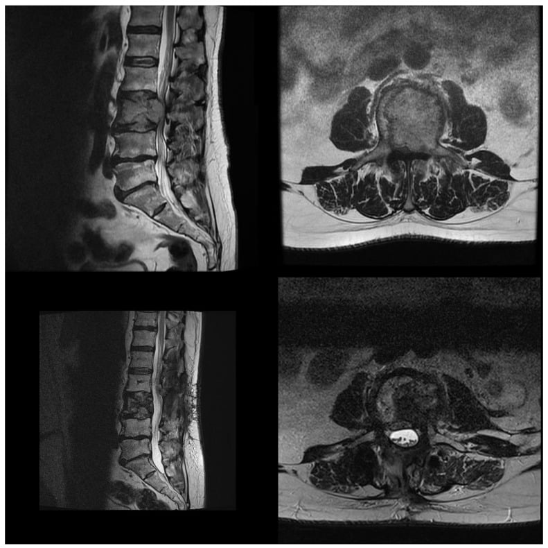 Preoperative and postoperative MRI of L3 renal-cell metastasis treated with separation surgery and carbon PEEK fixation