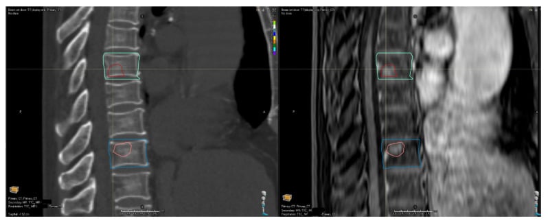 Co-registered simulation CT and MRI for multilevel thoracic spine stereotactic radiotherapy