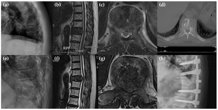 Serial radiograph CT and MRI showing pathological collapse after radiotherapy for T10 metastasis