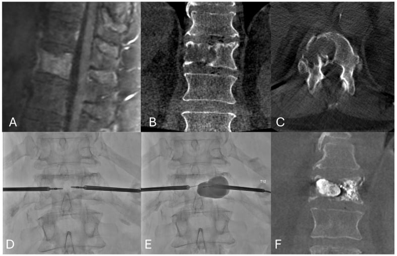 MRI CT fluoroscopy and procedural sequence for thermal ablation and kyphoplasty of a lytic spinal metastasis