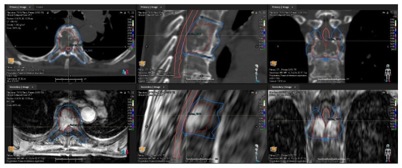 Registered CT and contrast MRI with GTV CTV and spinal cord contours for thoracic spine SBRT