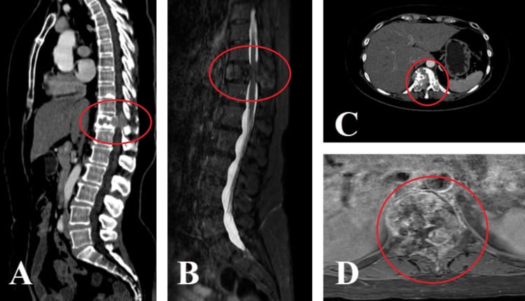 CT and MRI of T11 metastatic pathological fracture with posterior-wall displacement and canal invasion