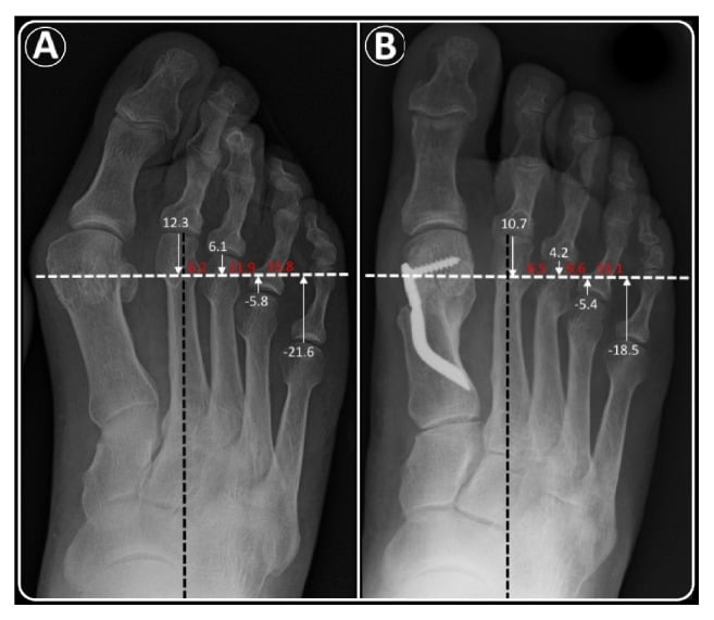 Weight-bearing radiographs marked for Maestro metatarsal length measurements