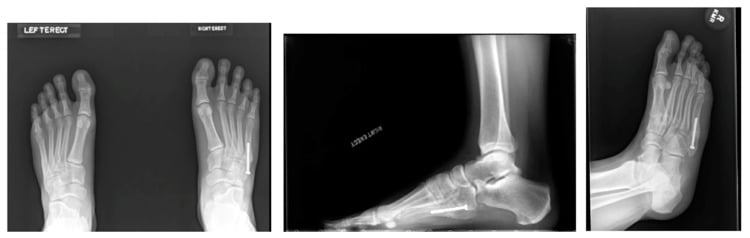 Weight-bearing radiographs after intramedullary screw fixation of a Jones fracture