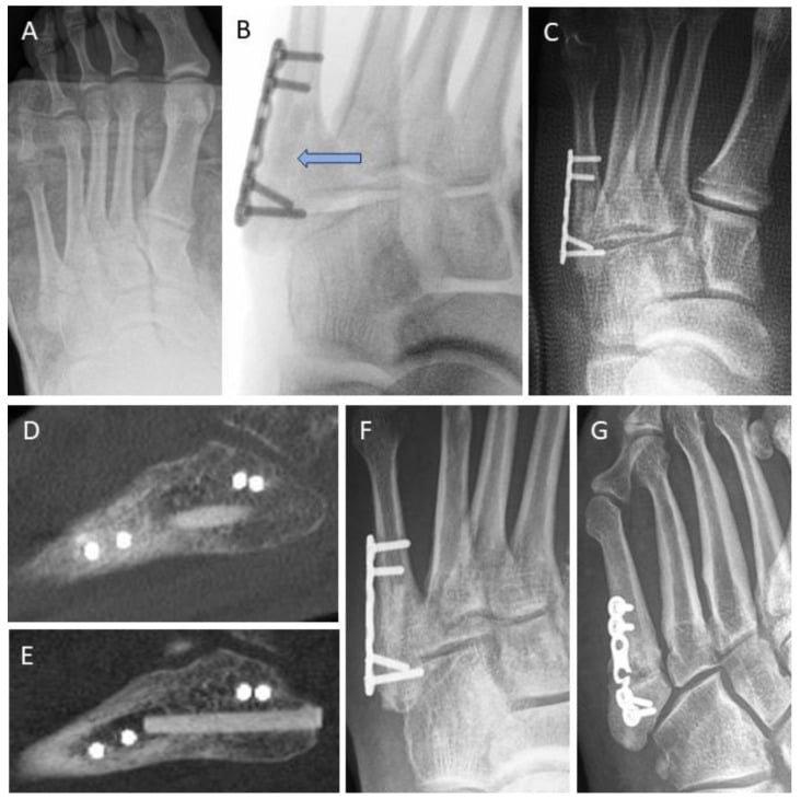 Serial radiographs and CT of painful fifth metatarsal nonunion and revision fixation