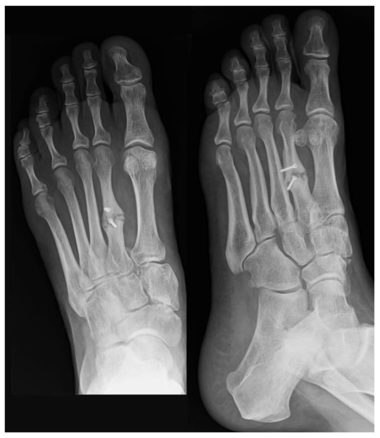 Weight-bearing radiographs showing second metatarsal nonunion and disturbed metatarsal formula