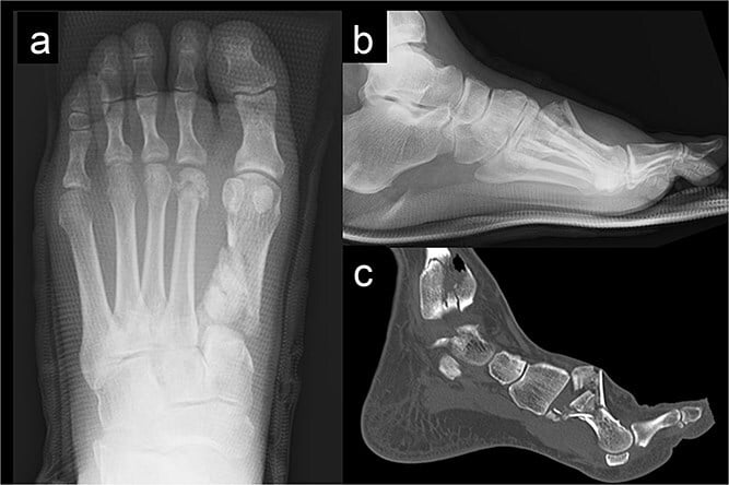 AP lateral radiographs and sagittal CT of a comminuted first metatarsal fracture