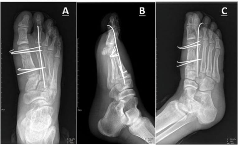 AP lateral and oblique radiographs after pin fixation of first and second metatarsal fractures