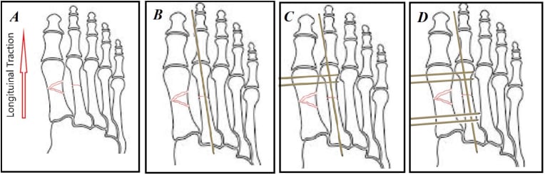 Illustrated sequence for longitudinal traction intramedullary wiring and transverse metatarsal pinning