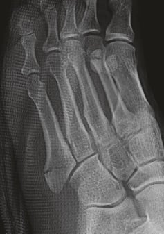 Radiograph of a proximal fifth metatarsal fracture at the junction of the tuberosity and metaphysis