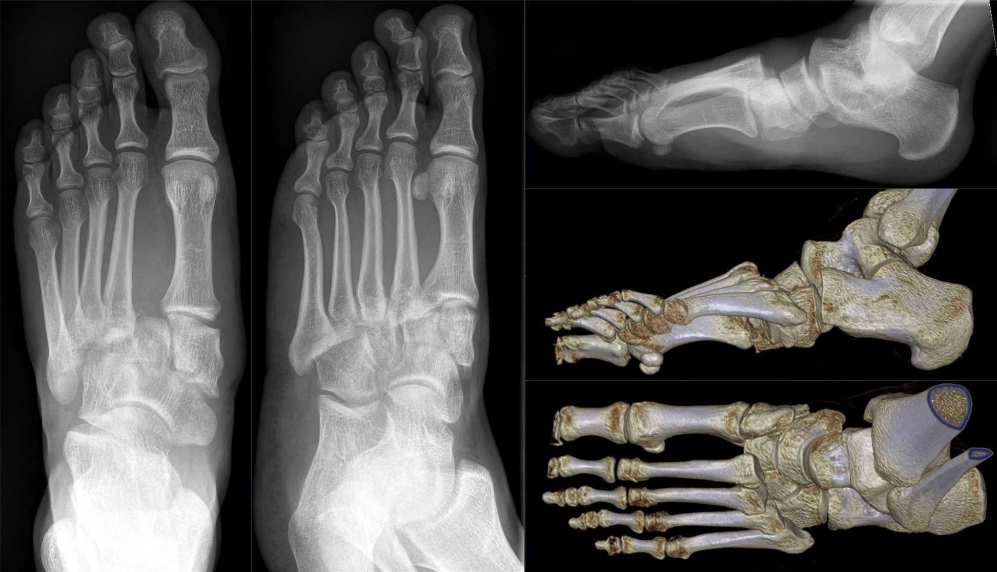 Multi-modal imaging of a Lisfranc fracture-dislocation: AP, oblique and lateral radiographs plus 3D CT reconstructions