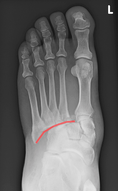 AP oblique foot radiograph with the tarsometatarsal (Lisfranc) joint line traced