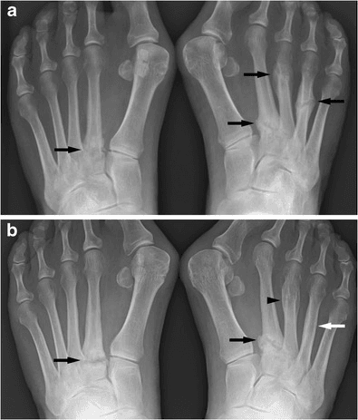 PA radiographs of both feet showing multiple metatarsal stress fractures with callus at different stages of healing.