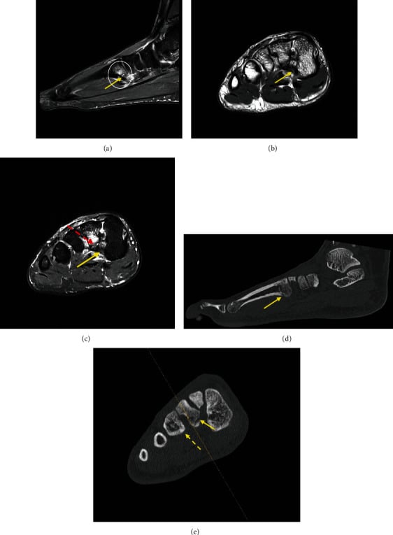 Sagittal and axial fat-suppressed proton density MRI showing marrow oedema and intracortical signal at the base of the second metatarsal