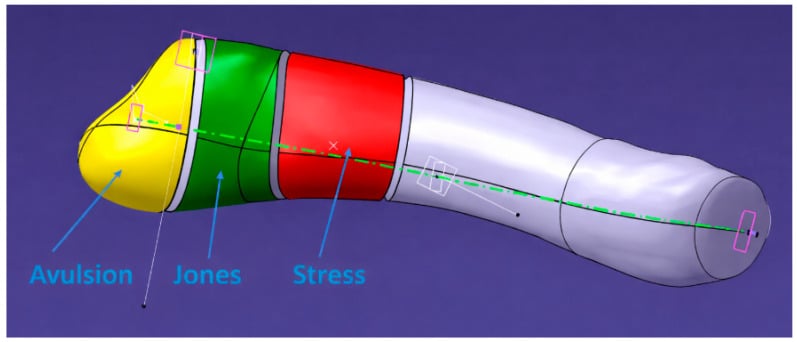 Colour-coded three-dimensional model of the proximal fifth metatarsal distinguishing avulsion, Jones and stress fracture zones